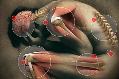Arthrite et inflammation Image 1